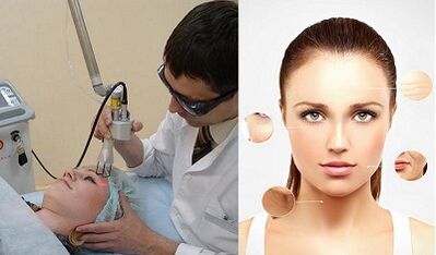 Bagaimanakah peremajaan kulit laser dilakukan